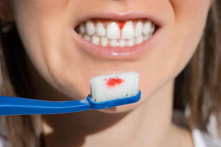 How the Romans Beat Us in Gum Disease