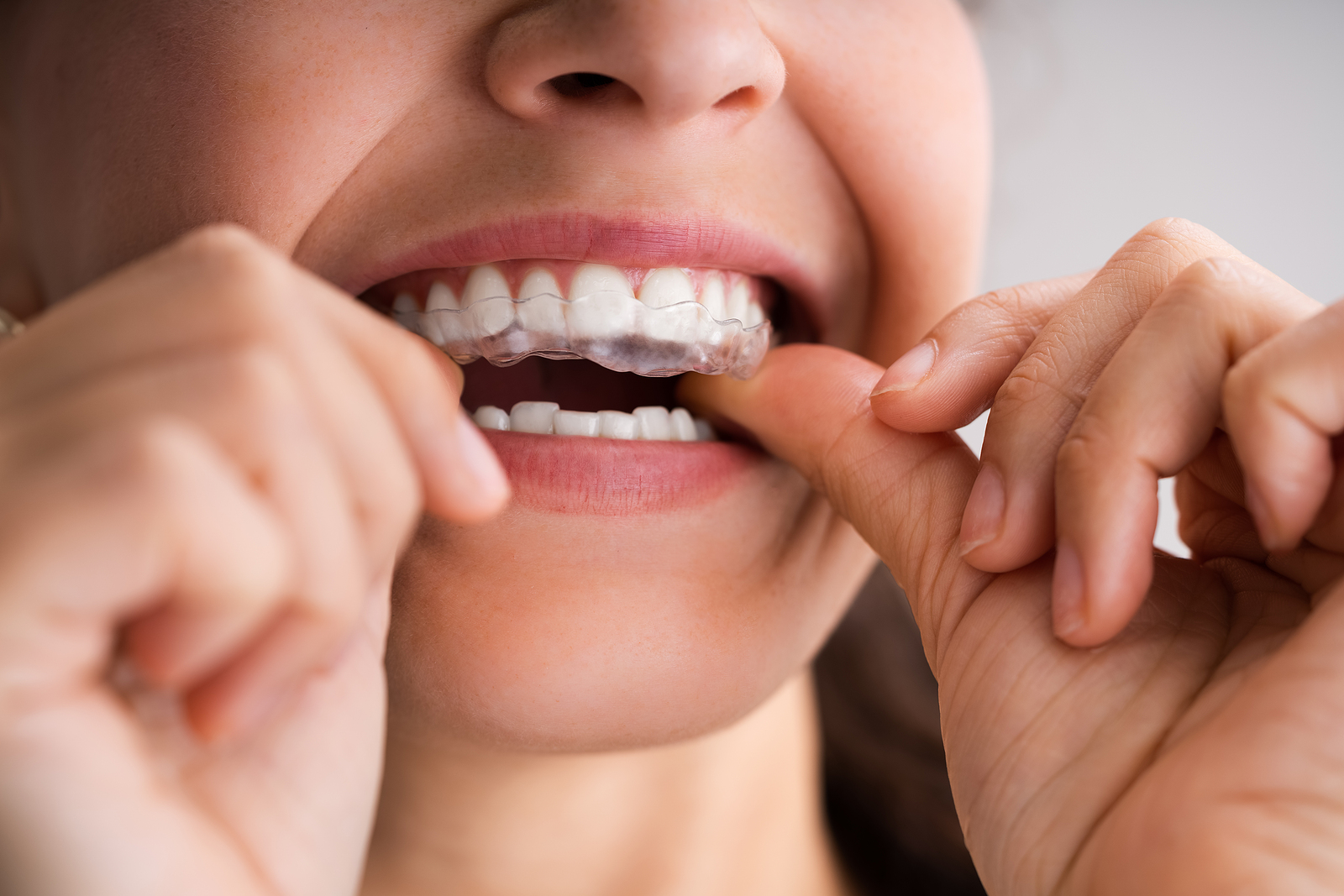 Invisalign Procedure